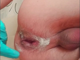 handsome wasting away twink with ruptured prolapse makes fisting to himself porn gay hot caress